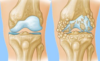 Illustration comparing a healthy knee joint to an arthritic knee joint